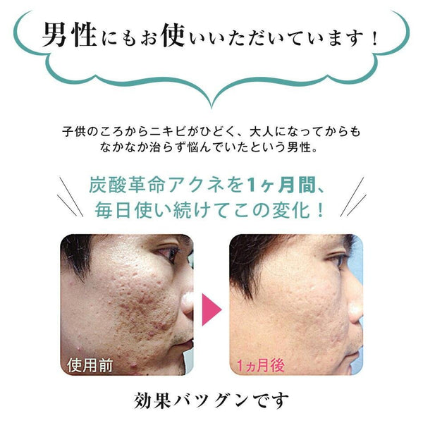 炭酸革命 ニキビケア炭酸フェイストリートメント 1セット