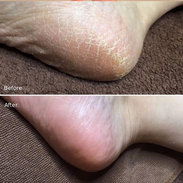 リベルタ ベビーフット 角質除去フットピール（男性用）60分トリートメント